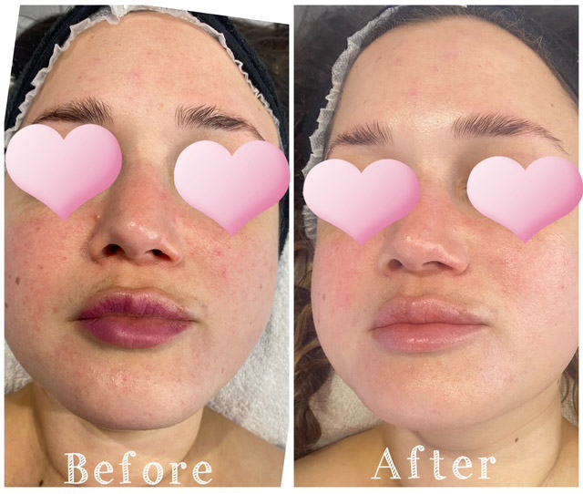 Oxygen Therapy with Peel and LED